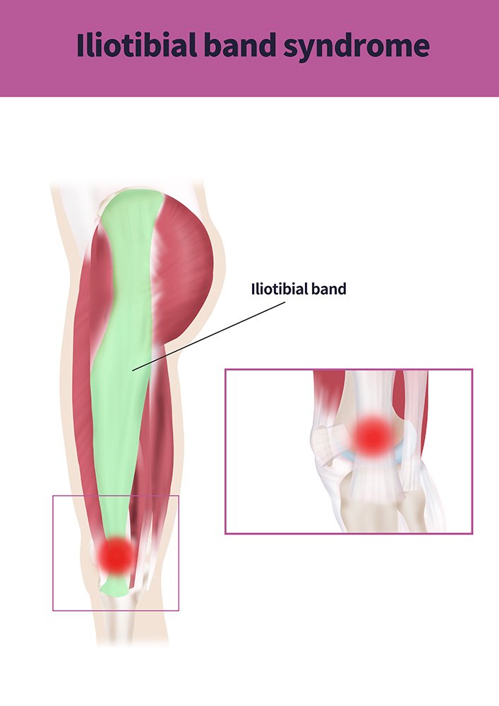 bandelletta ileotibiale