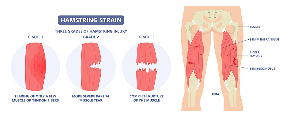 infortuni hamstring