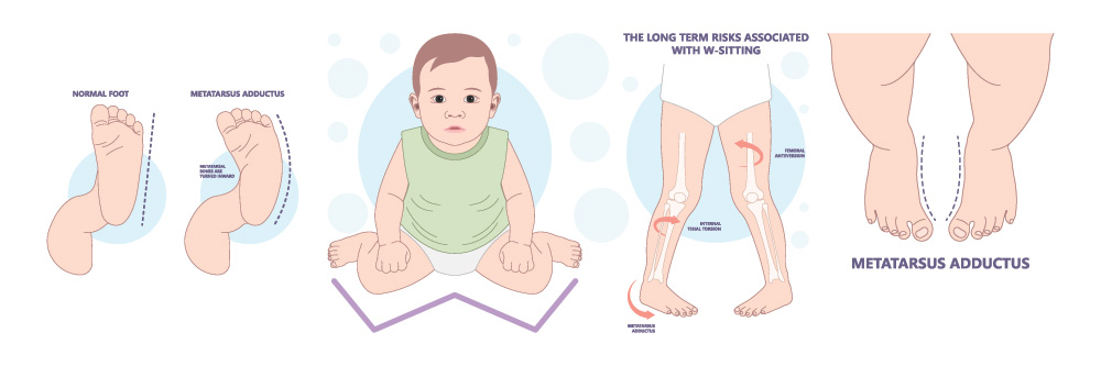 sintomatologia ginocchio valgo