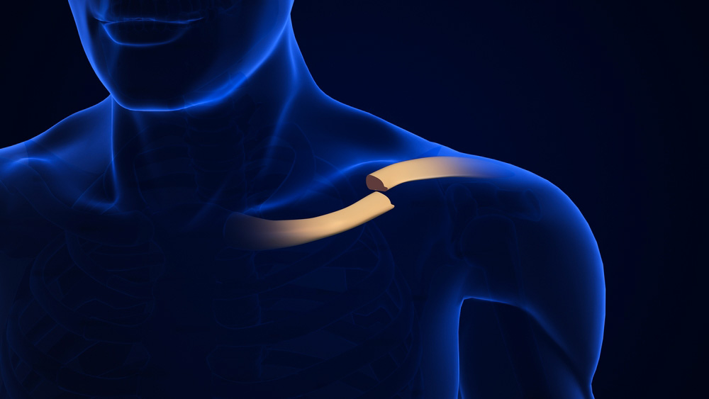 frattura clavicola