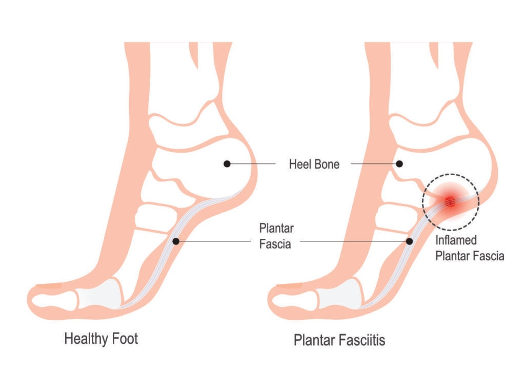 fascite plantare